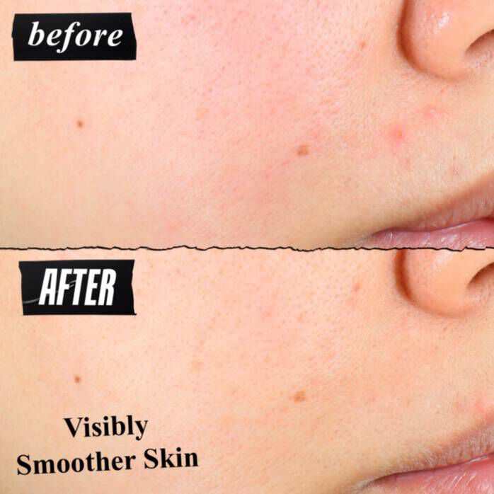 Clearly Corrective™ Daily Re-Texturizing Triple Acid Peel