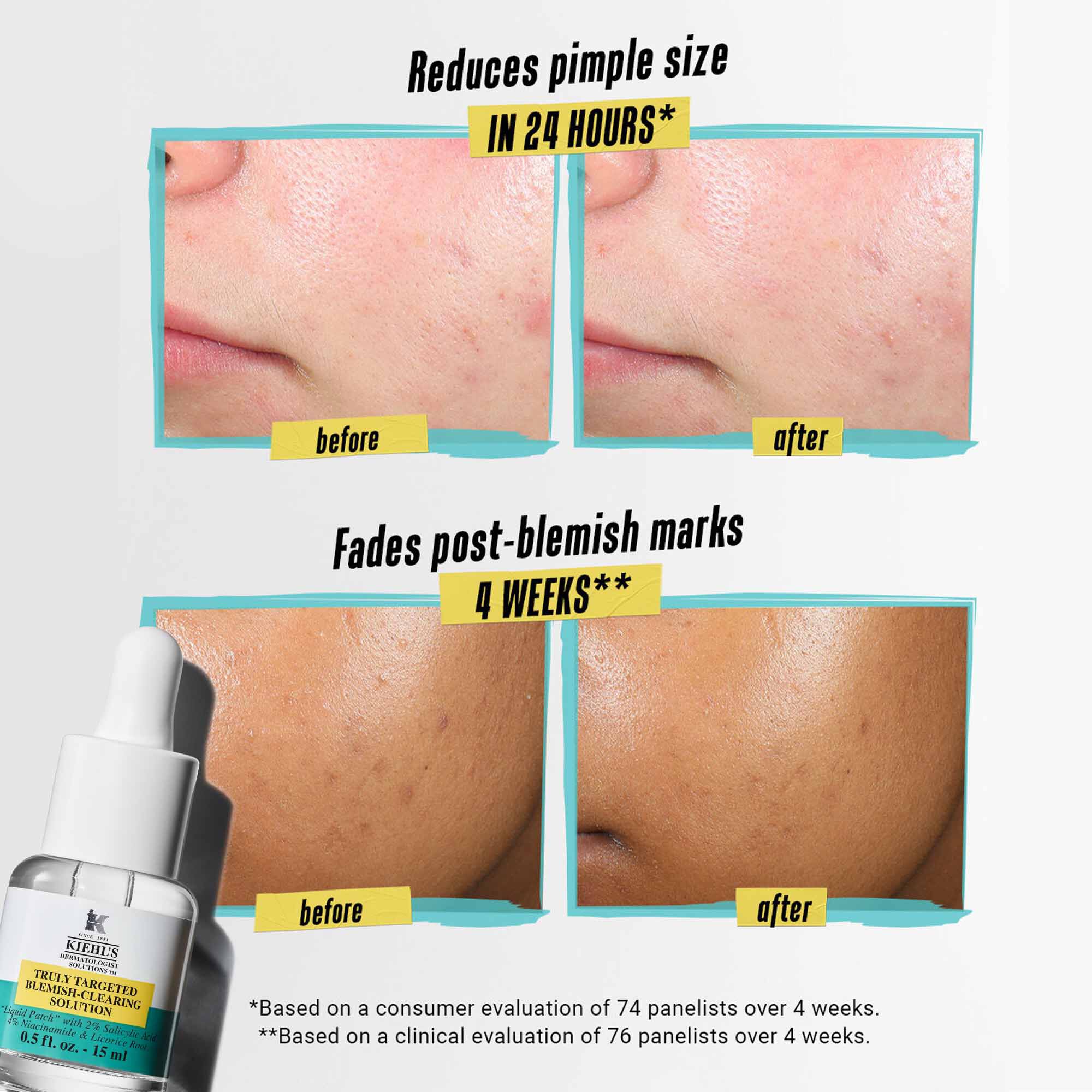 Truly Targeted Blemish-Clearing Solution